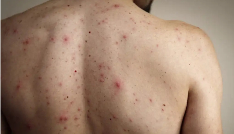 Se confirmó un nuevo caso de sarampión importado en el país: es un joven de 29 años