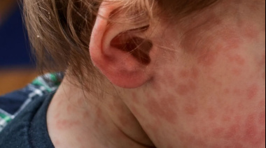 Estudian un nuevo caso sospechoso de sarampión en Entre Ríos