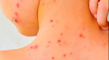 Detectaron un posible caso de sarampión en otra localidad entrerriana