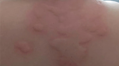 Arrojaron un balde con hormigas a un niño en medio de los festejos por carnaval